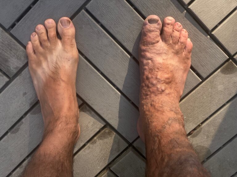 Quick health update… as we prepare to walk.